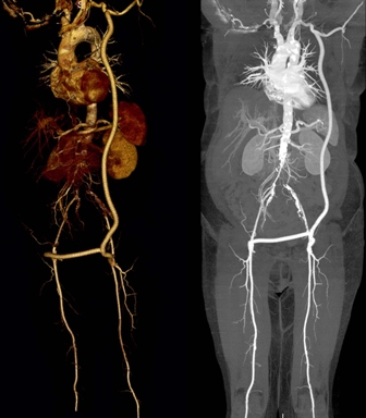 Рентген с контрастом для определения кровотечения