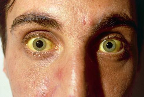 Пигментация глаз при гепатозе