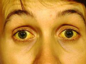 Пожелтение кожи и белков глаз