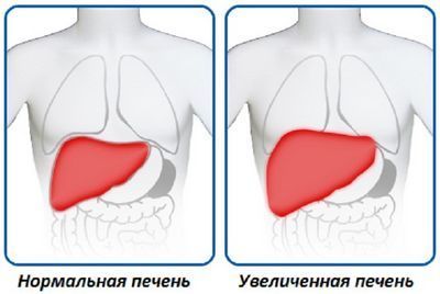 Размеры органа при гепатомегалии