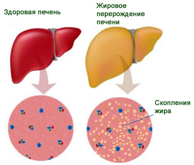 Стеатоз органа