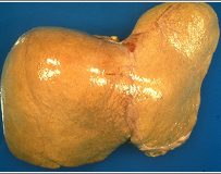 Деградация печени при жировом гепатозе
